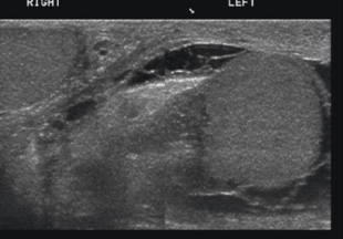 <p>assoc findings of epididymo-orchitis</p>