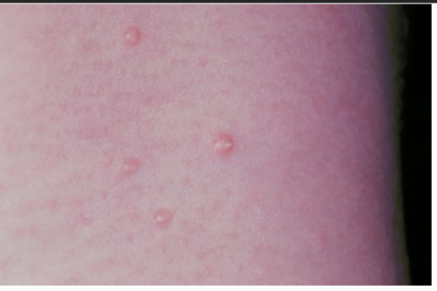 <p>Hint: children & young adults; predominantly on skin of neck, face, trunk, & genitalia (Mucosa rare)</p>