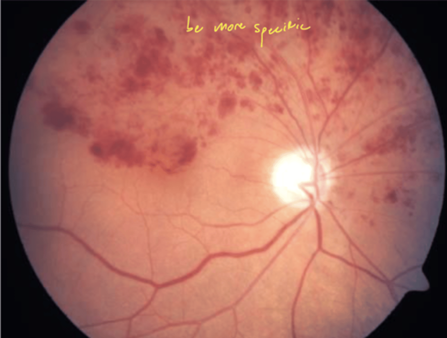 <p>same as CRVO and BRVO but affect 1 hemisphere of retina:</p><p>1. dot-blot and flame shaped hemes</p><p>2. retinal neovascularization</p><p>3. macular edema</p>