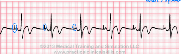 <p>The small vertical line seen on the EKG is indicative of a _________ heartbeat</p><p>-the position of the vertical line speaks to where the pacemaker was placed in the heart</p>