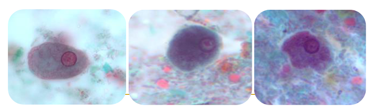 <ul><li><p><span>Large nucleus—up to 1/3 of the size of the cyst</span></p></li><li><p><span>Pleomorphic karyosome (small/large, compact/diffuse, central/eccentric)</span></p></li><li><p><span>Peripheral chromatin, evenly distributed but can be light or heavy</span></p></li><li><p><span>Chromatoid bodies highly variable in size and shape</span></p></li></ul><p></p>