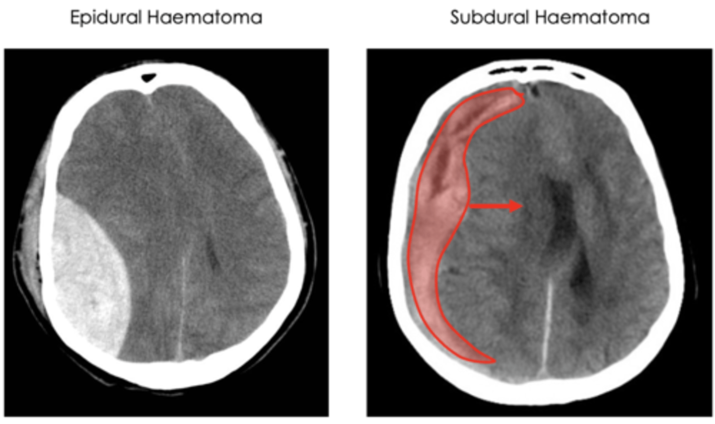 <p>- occurs with violent shaking of head which snaps bridging veins between dura mater and subarachnoid space, haematoma causes mass effect midline shift of brain</p><p>- classified with crescent-shaped haematoma not contained by dura, but is contained by falx cerebri and tentorium cerebelli</p>