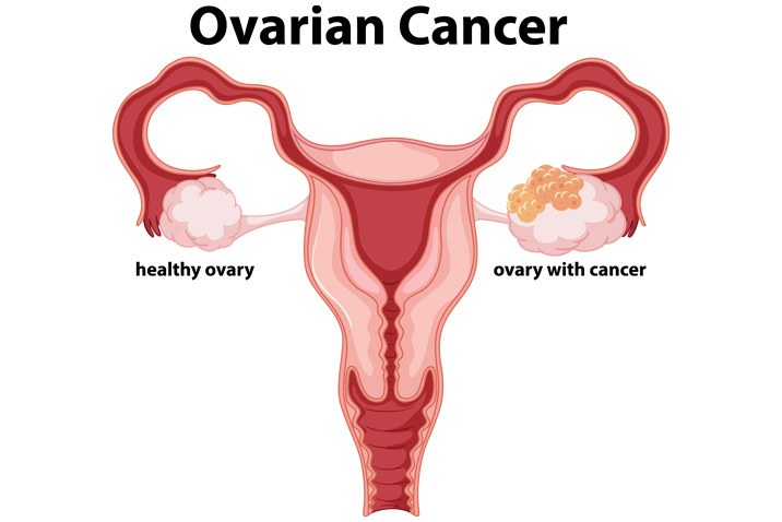 <p>Ovarian cancer</p>