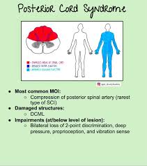 <ul><li><p><strong>UMN</strong></p></li><li><p>least frequent</p></li><li><p><strong><mark data-color="blue" style="background-color: blue; color: inherit">loss of dorsal column bilaterally</mark></strong></p></li><li><p><strong><mark data-color="purple" style="background-color: purple; color: inherit">LOSS</mark></strong></p><ul><li><p><strong>bilateral </strong>prop, vibration, pressure, stereognosis, discrimination</p></li></ul></li><li><p><strong><mark data-color="purple" style="background-color: purple; color: inherit">KEEP</mark></strong></p><ul><li><p>motor function, pain, temp, light touch</p></li></ul></li></ul><p></p>