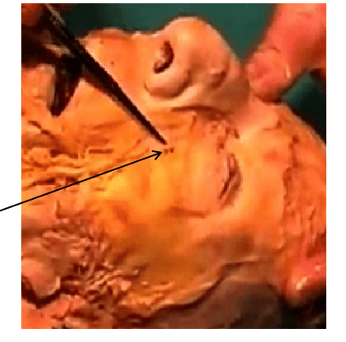 <p>infraorbital nerve on top of probe after locating the infraorbital foramen</p>