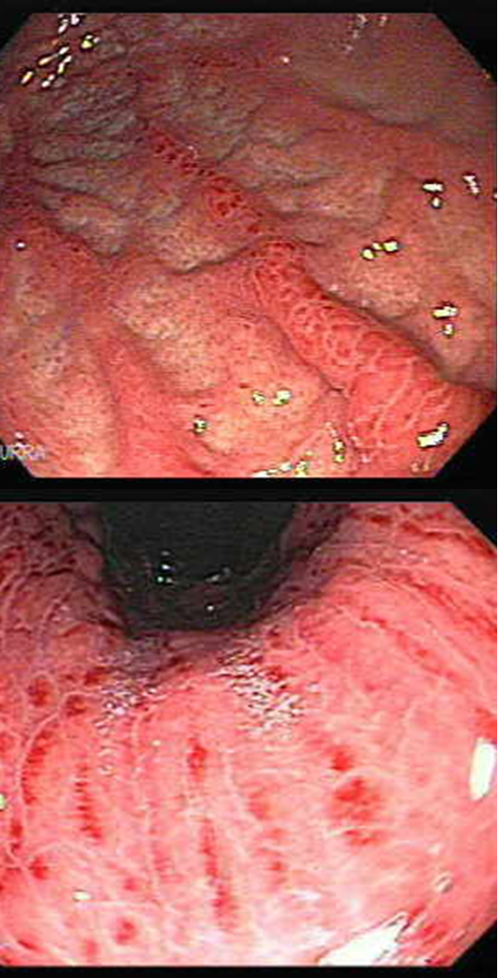 <p>upper endoscopy → sub epithelial hemorrhages, petechiae, erosions</p>