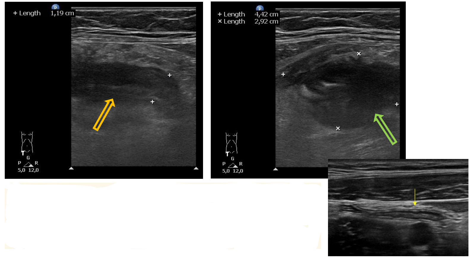 <p>Patient history: acute right lower-quadrant abdominal pain in a young woman with normal body weight</p><p>Modality: sonogram of the appendix (linear 7,5–10 MHz probe), B-mode</p><p>Region: appendix, longitudinal and cross-sectional views</p><p>Radiologic sign: left image – thickened (12 mm), non-compressible hypoechogenic tubular structure</p><p>(yellow arrow); right image – hypoechogenic periappendiceal fluid collection around the tip of the</p><p>appendix (green arrow); small inlet – normal appendix ultrasonography</p><p>Diagnosis: acute appendicitis with periappendiceal abscess</p>