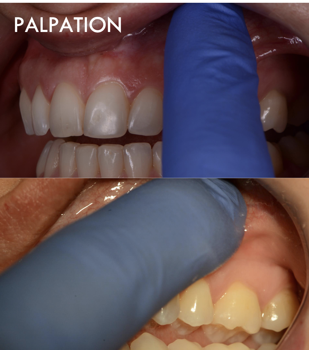 <ol><li><p>Soft Tissue Exam, palpation of the alveolar hard tissue (buccal and lingual)</p></li><li><p>Apply firm digital pressure to the mucosa covering the roots and apices.</p></li><li><p>Search for sensitive areas, that may indicate inflammatory process.</p></li><li><p>Test the quadrant and compare right side vs. left side</p></li></ol><p></p>