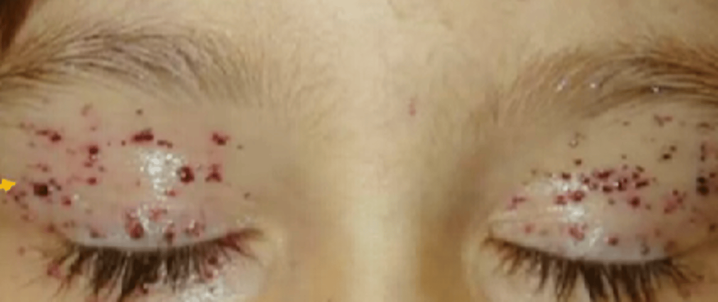 <p>benign lesions of blood vessels appearing as dark spots on the skin, as seen in Fabry's disease.</p>