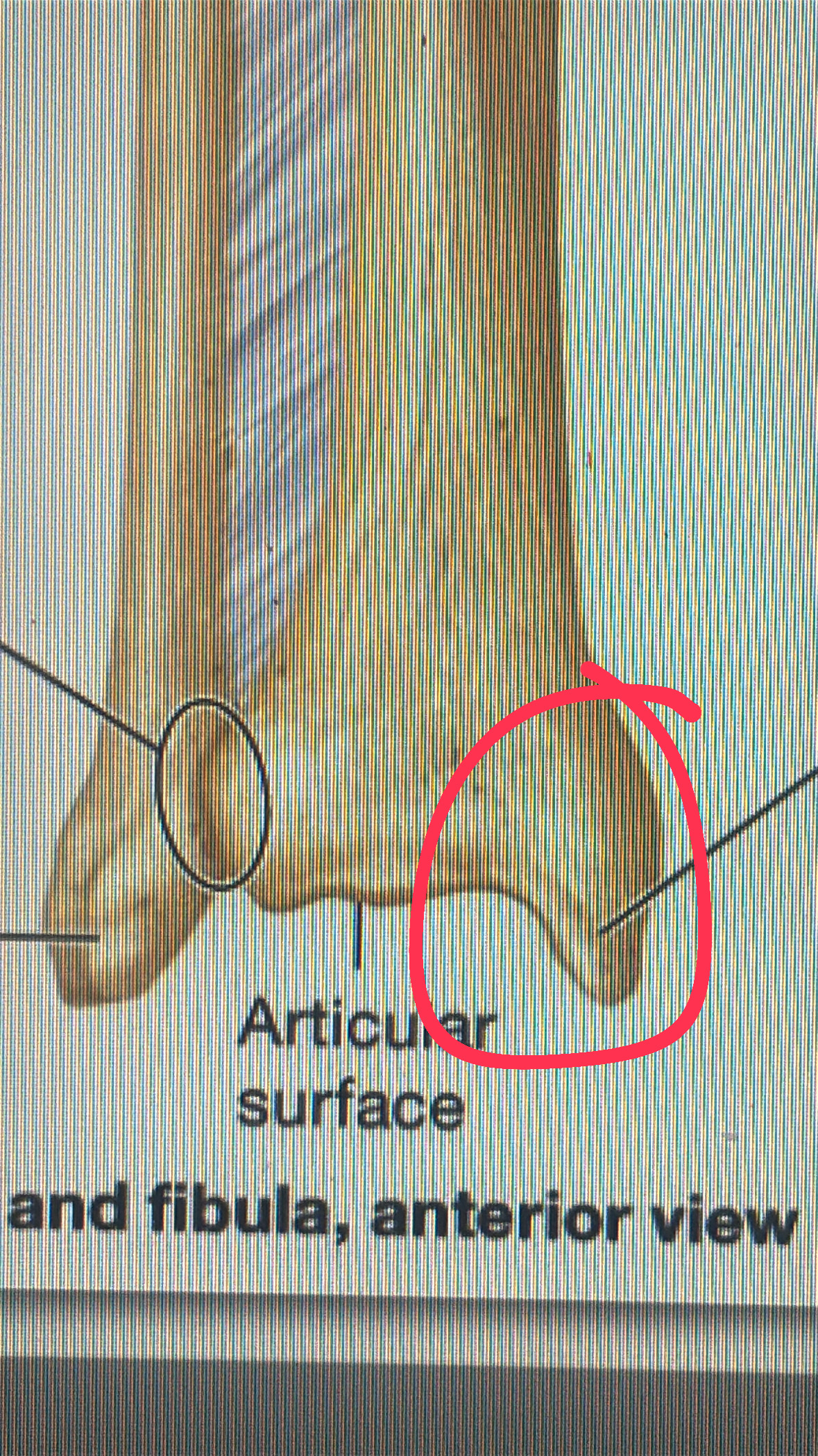 <p>the bottom medial horn of the tibia</p>