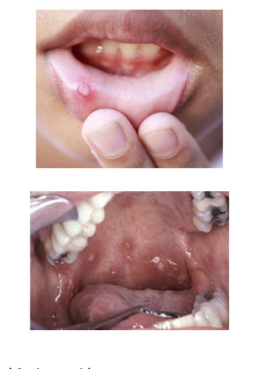 <p>ulcers = canker sores</p><p>-solitary or multiple</p><p>-RAS = recurrent aphthous stomatitis</p><p>-associated with crohn's disease **</p>