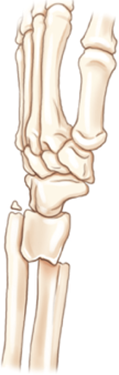<p>Posterior displacement of distal radius</p>