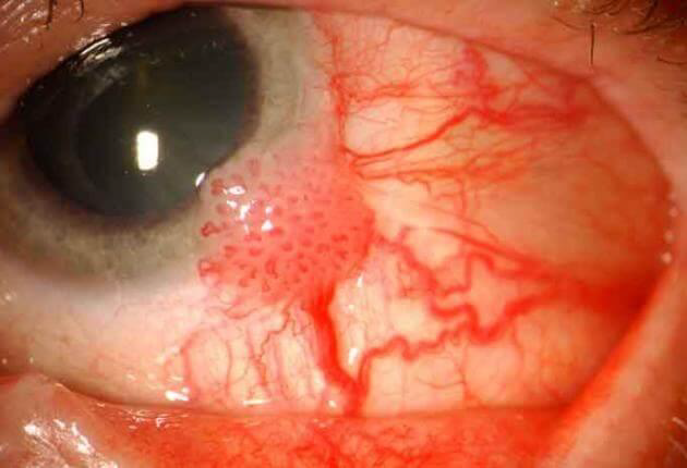 <p>Squamous cell carcinoma of the Conjunctiva and Cornea</p><p>N/E: Thickened well-demarcated leukoplakic lesion at the corneal limbus extending into the corneal center. M/P:</p><p>1.Replacement of the epithelium by atypical cells.</p><p>2.Mitoses are common.</p><p>3.Usually “insitu or intra-epithelial neoplasia”.</p><p>4.Occasionally invade deeper structures with central keratinization.</p>