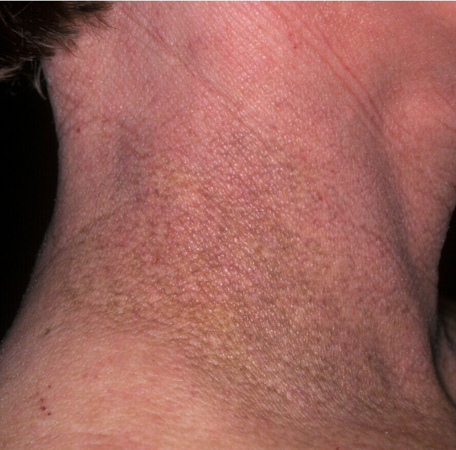 <ul><li><p>Atopic dermatitis in <strong>infants </strong>and<strong> children (0-5 years)</strong> generally manifests at the levels of the <mark data-color="#ebed45" style="background-color: #ebed45; color: inherit">cheeks</mark> (with sparing of the periorbital and perioral regions), <mark data-color="#dbed31" style="background-color: #dbed31; color: inherit">extensor</mark> surfaces of the legs and the <mark data-color="#e9f542" style="background-color: #e9f542; color: inherit">trunk</mark>.</p></li><li><p>In <strong>Children (6-11 Years)</strong>, it has a <mark data-color="#d7aef2" style="background-color: #d7aef2; color: inherit">flexural distribution</mark> with other characteristic manifestations such as <mark data-color="#e2b8fa" style="background-color: #e2b8fa; color: inherit">atopic dirty neck</mark> and "<mark data-color="#d69cec" style="background-color: #d69cec; color: inherit">dry" eczem</mark>a, with exudative lesions becoming crusts.</p></li><li><p>In <strong>adolescents</strong> and <strong>adults</strong>, the areas most involved are the scalp, head, eyelids, neck, shoulders, upper trunk, folds, hands, wrists, feet. </p></li></ul><p></p>