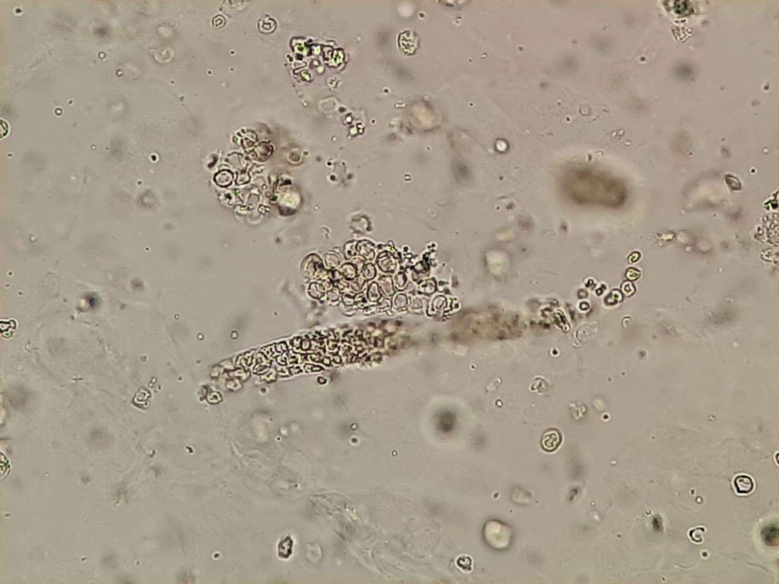 <p>glomerulonephritis</p>