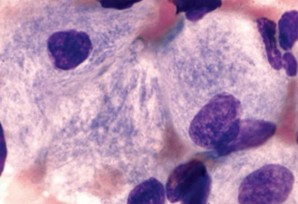 <p>● Most common lysosomal storage disorder</p><p>● Defect or deficiency in the catabolic enzyme</p><p>B-glucocerebrosidase (necessary for glycolipid</p><p>metabolism)</p><p>● Unmetabolized substrate sphingolipid</p><p>glucocerebrosidase accumulates in the lysosomes</p><p>of macrophages throughout the body, including</p><p>microglia (CNS) and osteoclast (bone)</p><p>● Found in:</p><p>○ Spleen</p><p>○ Liver</p><p>○ Bone marrow</p><p>● Lysosome-engorged macrophages with eccentric</p><p>nucleus</p><p>● Fibrillar blue-gray cytoplasm with a striated or</p><p>wrinkled appearance (onion skin-like or</p><p>crumpled tissue paper)</p><p>● Stain positive with:</p><p>○ PAS</p><p>○ ACP</p><p>○ trichrome</p><p>○ aldehyde fuchsin</p>