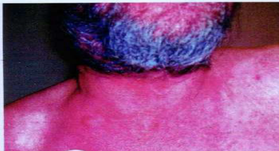 <p>disease; caused by?</p>
