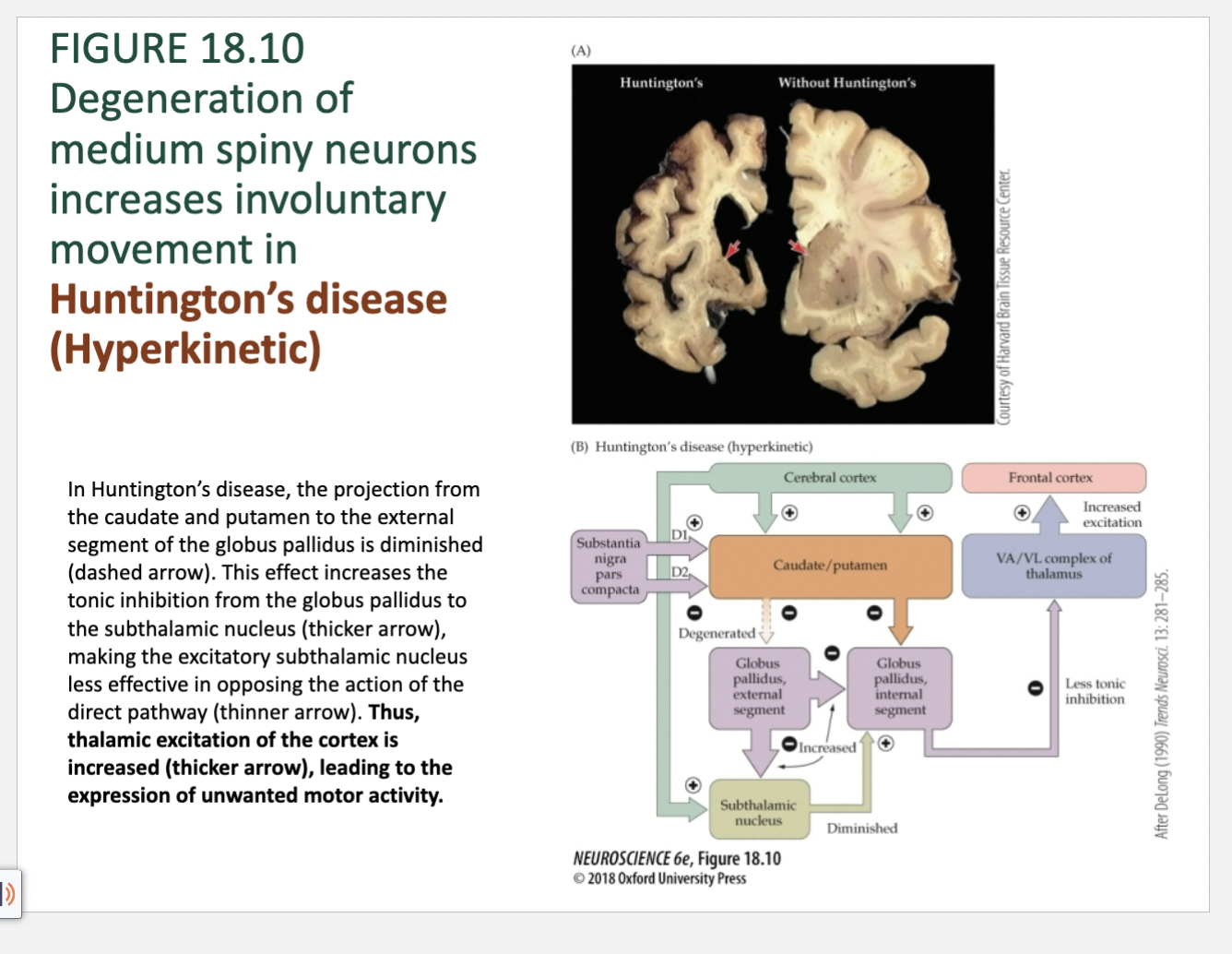 <p>Figure 18.10- Neuropathology of Basal Ganglia – Huntington’s</p>