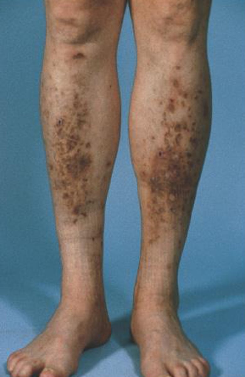 <p>Light brown scaly patches that do not hurt, open up, or itch (d/dx from venous stasis); may develop secondary to DM</p>