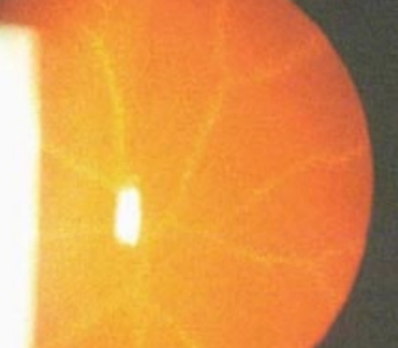 <p>cataract type seen in Fabry's disease</p>
