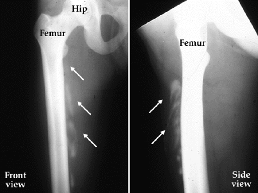 <p>calcification of soft tissues after trauma; may require surgery to remove</p>