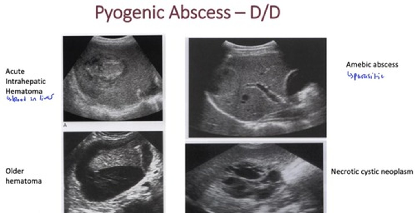 <p>- hematoma</p><p>- other abscesses (amebic)</p><p>- necrotic cystic neoplasm</p>