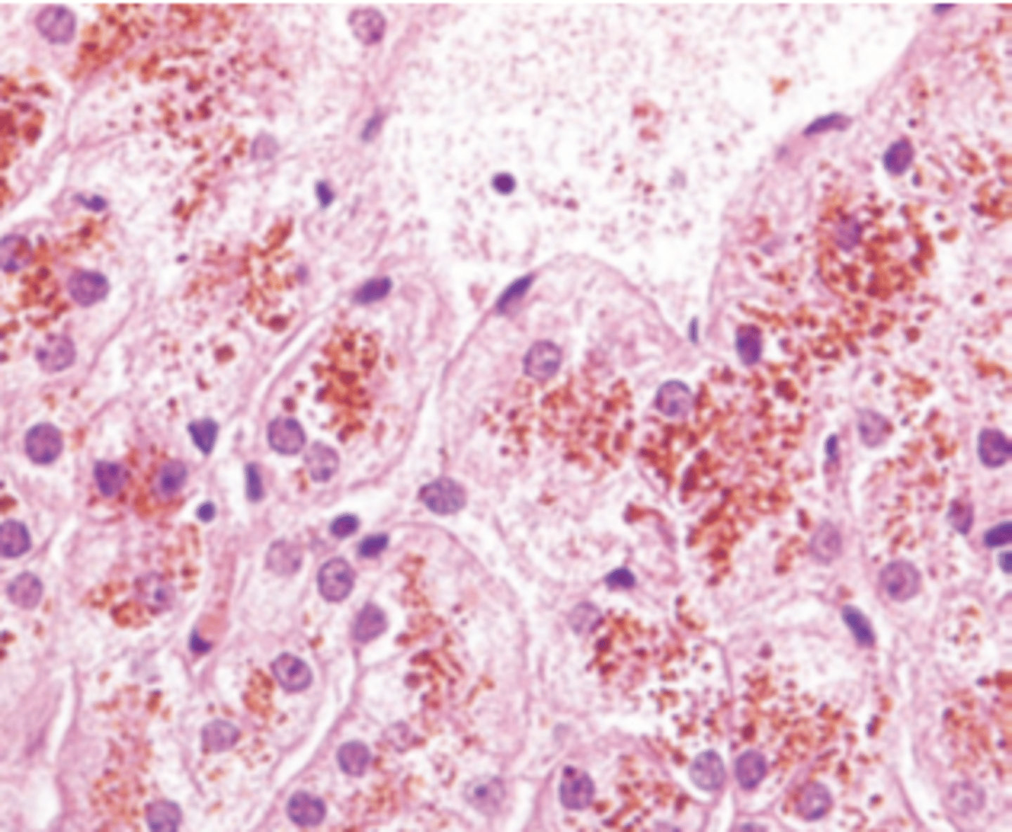 <p>A 22-year-old man presents with a 3-week history of yellow skin and sclerae but is otherwise asymptomatic. He recalls a similar episode 2 years previously. Occasionally, he has noticed dark-colored urine. The serum bilirubin is 4.4 mg/dL, mostly in the conjugated form. Serum AST and ALT levels are normal. A liver biopsy is shown in the image. Which of the following is the most likely diagnosis?</p><p>(A) α1-Antitrypsin deﬁciency</p><p>(B) Crigler-Najjar syndrome</p><p>(C) Dubin-Johnson syndrome</p><p>(D) Gilbert syndrome</p><p>(E) Wilson disease</p>