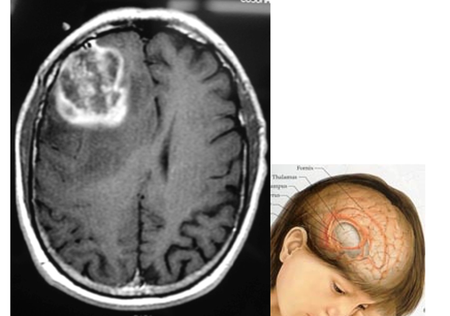 <p>brain tumor that originates in the brain</p><p>- radiotherapy most affective, chemo cat get through BBB</p><p>- compression causes the issues</p>