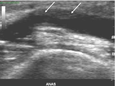 <p>Patient is s/p LE bypass graft x 3 years. Patient has not had previous ultrasound exam for 2 years. </p><p>You obtain this image and the white arrows most likely indicate which of the of following? </p>