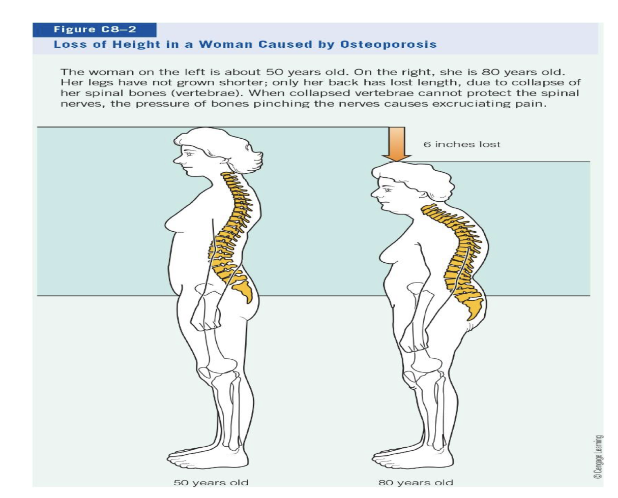 <p>caused by osteoporosis&nbsp;</p>