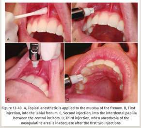 <p>-patients appreciate this- less painful, good to do in kids</p>
