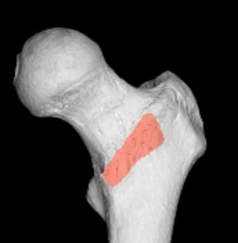 <p>anterior ridge connecting trochanters </p>