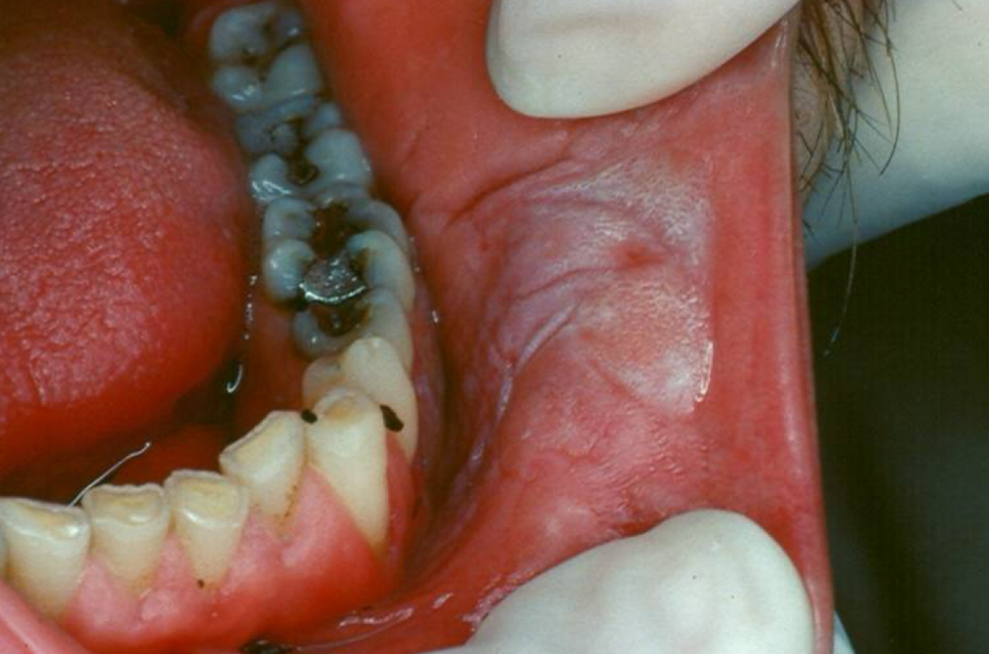<p>Leukoplakia </p>