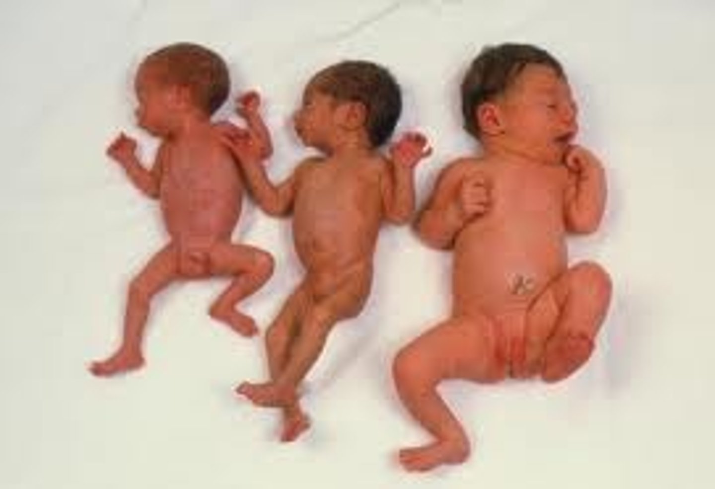 <p>Low Birth Weight</p>