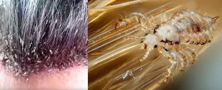 <ul><li><p><strong><u>Infestation</u>:</strong></p><ul><li><p>Transmitted from human hair.</p></li><li><p>Nits are attached to the hair shaft.</p></li></ul></li><li><p><strong>Nursing Management:</strong></p><ul><li><p>Assess with a bright light and magnifying glass.</p></li><li><p>Nit removal/pediculicide shampoo.</p></li><li><p>Prevention and environmental control.</p></li></ul></li></ul><p></p>