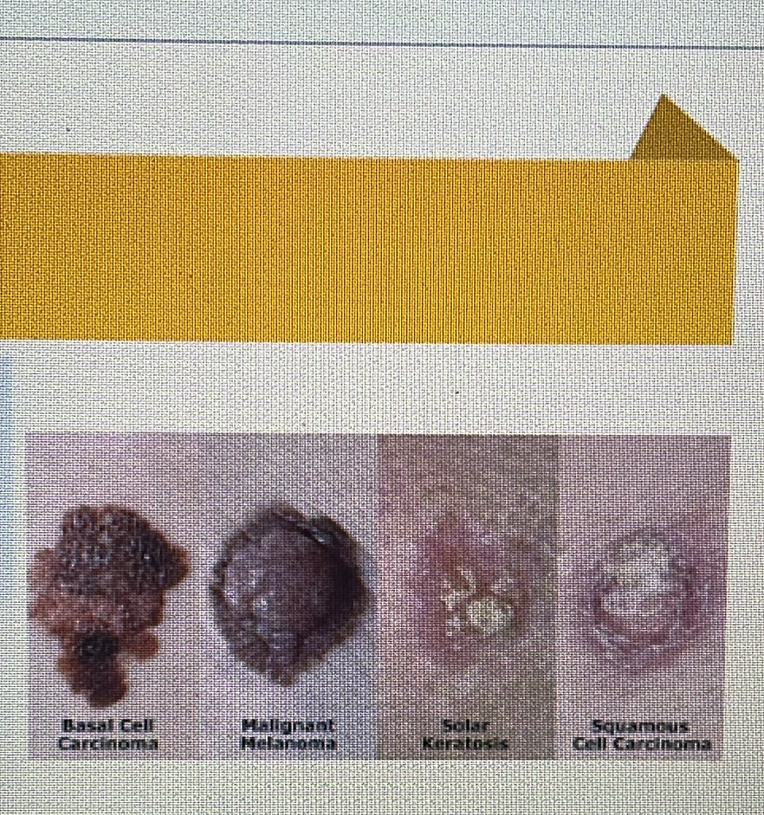 <p>melanoma</p>