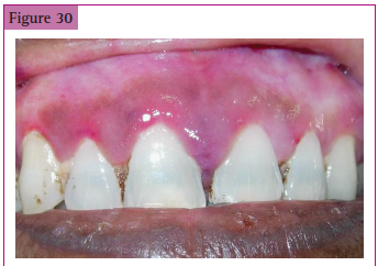 <p>________________ of teeth due to ___________</p>