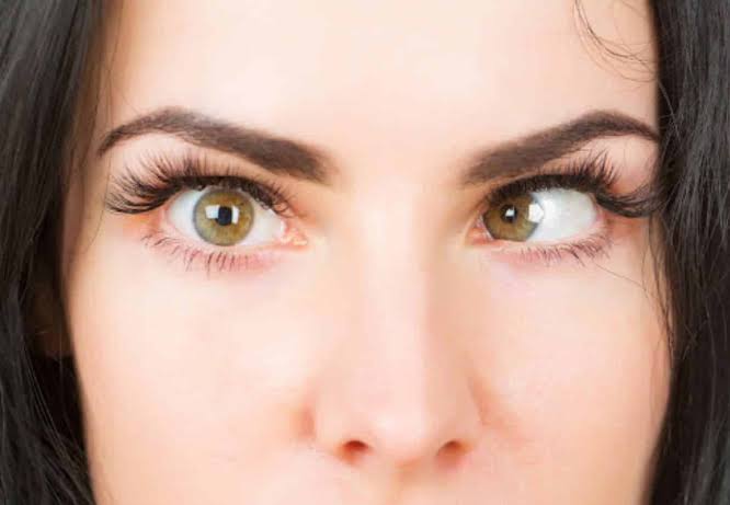 <p></p><p>Noticeable only with the cover test,  is less likely to cause amblyopia than strabismus.</p><p></p>