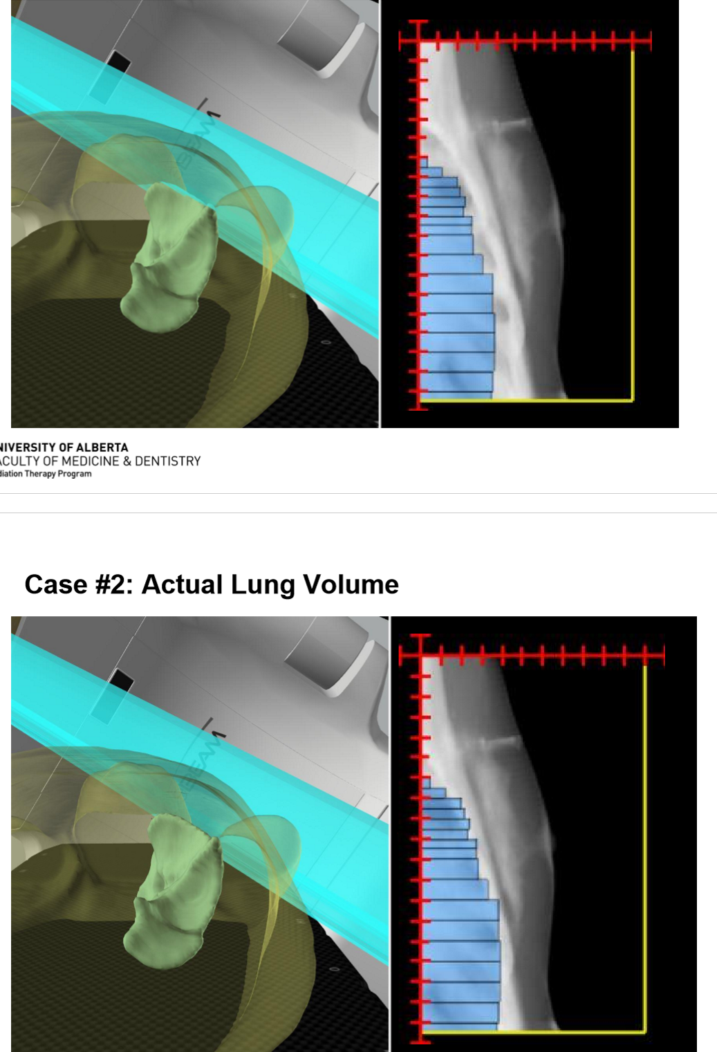 <p>in the actual lung volume, there is less lung emerging anterior to the MLCs then what was orignally planned</p>
