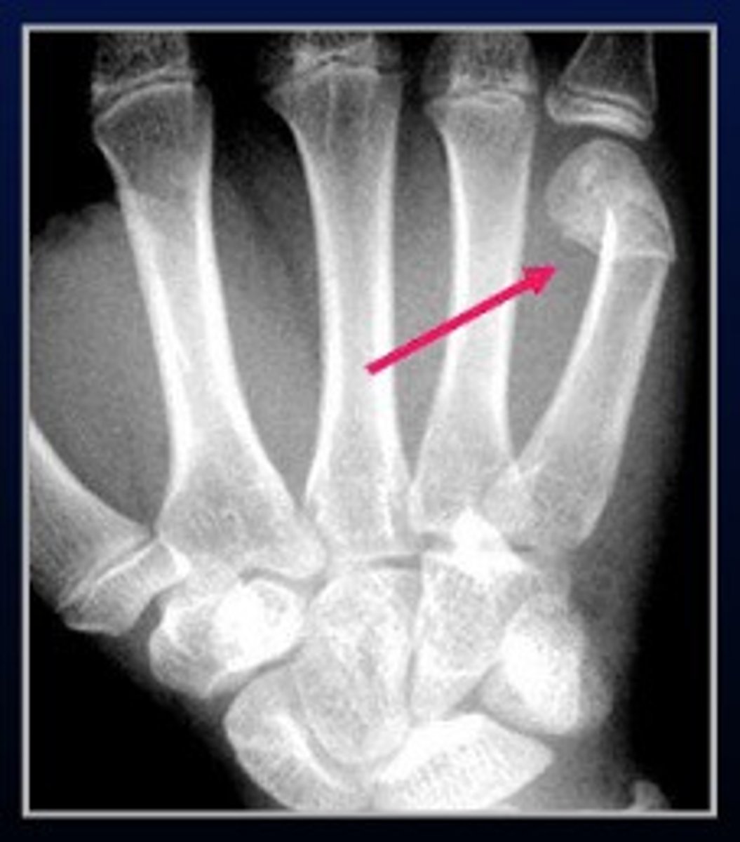 <p>fracture of the distal end of fourth or fifth metacarpal</p><p>- phalanges won't be parallel</p>