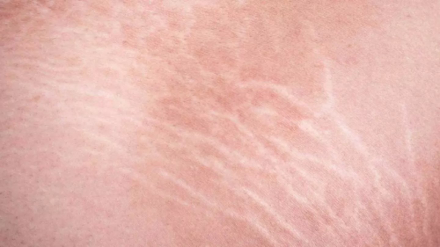 <p>Also known as Striae or Striae distensae, are a form of scarring on the skin with an off-color hue. Over time they may diminish, but will not disappear completely. Caused by tearing of the dermis during periods of rapid growth of the body, such as during puberty or pregnancy.</p>