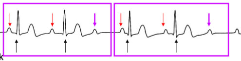 <p><span>the AV node conducts only some of the supraventricular depolarisations:</span><br><span>- some P waves are followed by QRS complexes</span><br><span>- other P waves are not followed by a QRS complex</span></p><p></p><p><span>In this example there are 3 P waves for every 2 QRS complexes (3:2 ratio)</span><br><span>- other ratios are possible (e.g, 2:1)</span></p><p></p><p><span>Caused by increased injury to the AV node</span></p>