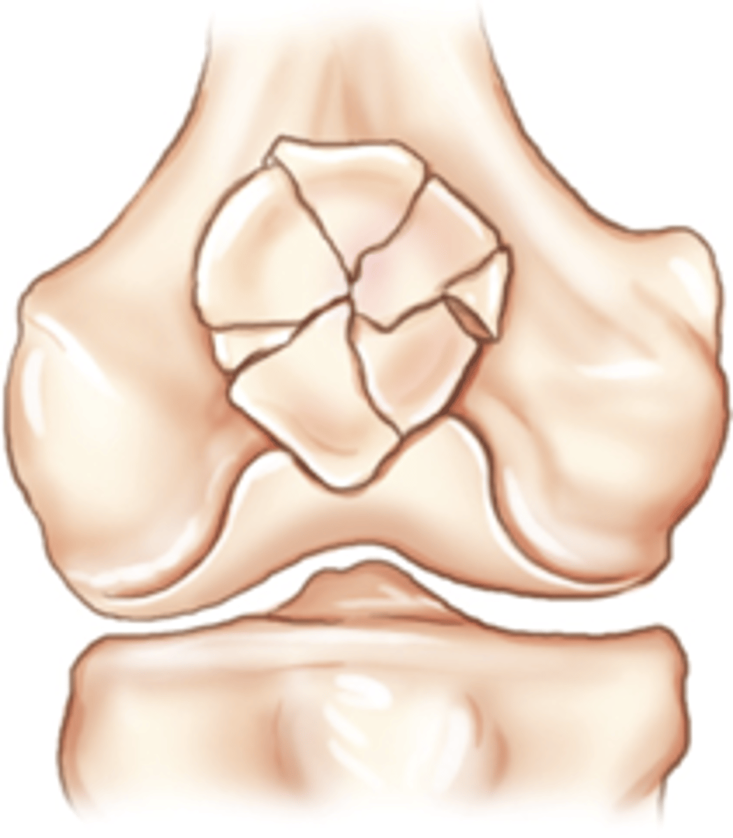 <p>Fracture lines radiate from a center point of injury</p>
