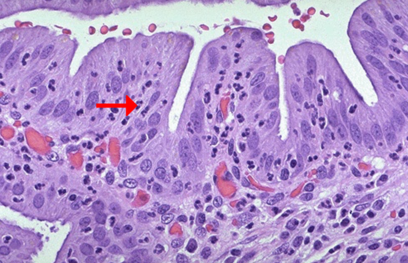 <p>Condition: Acute cholecystitis</p><ol><li><p>Neutrophil</p></li><li><p><span>right upper quadrant abdominal pain with tenderness on palpation</span></p></li><li><p>Most cases of cholecystitis occur in association with cholelithiasis (gallstones).</p></li></ol><p></p><p> Bacterial infection is typically absent from cases of acute and chronic cholecystitis.</p><p></p>