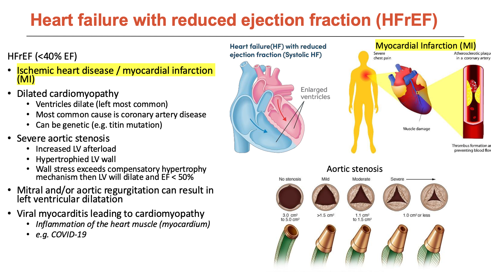 <ol><li><p>Ischemic heart disease / MI</p><ul><li><p>heart muscle does not get enough oxygen → non-contractile tissue</p></li><li><p>increases EDV (LV dilation)</p></li><li><p>ESV increases even more so (reduced contraction) - we want ESV to be low</p></li></ul></li><li><p>Dilated cardiomyopathy</p><ul><li><p>ventricles dilate (left most common)</p></li><li><p>most common cause is CAD</p></li><li><p>can be genetic (e.g. titin mutation</p></li></ul></li><li><p>Severe aortic stenosis</p><ul><li><p>increased LV afterload</p></li><li><p>hypertrophies LV wall</p></li><li><p>wall stress exceeds compensatory hypertrophy mechanism then LV will dilate and EF &lt; 50%</p></li></ul></li><li><p>Mitral and/or aortic regurgitation can result in LV dilation</p></li><li><p>Viral myocarditis leading to cardiomyopathy</p><ul><li><p>Inflammation of the heart muscle (myocardium) (e.g. COVID-19)</p></li></ul></li></ol><p></p>