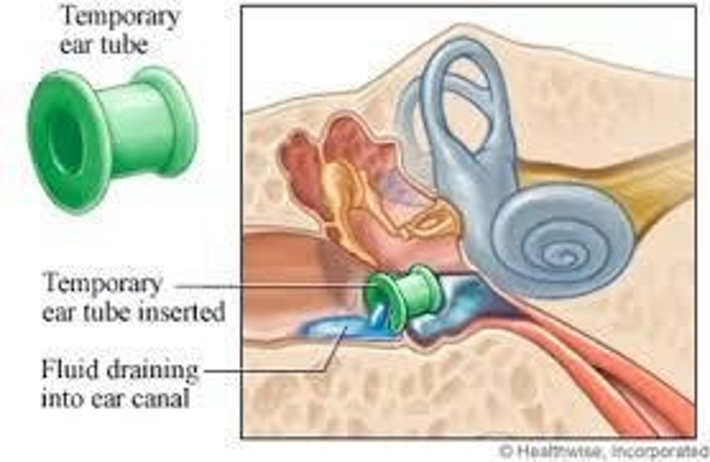 <p>Myringotomy and placement of tympanoplasty tubes, follow-up every 6 months, and antibiotics like amoxicillin or azithromycin.</p>