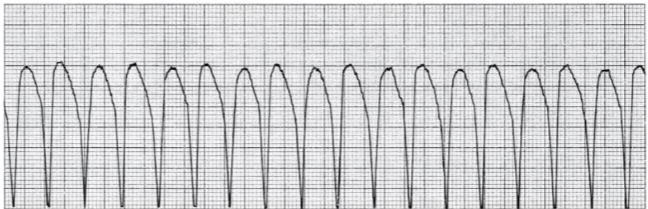 <p>Rate: 140-180 BPM<br>Rhythm: Regular<br>P-Wave: None or Buried<br>PR: None<br>QRS: Wide</p>