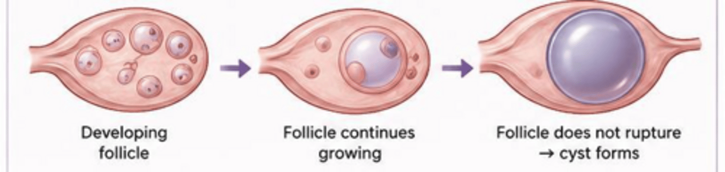 <p>Occurs when the dominant follicle fails to rupture or an immature follicle fails to undergo atresia.</p>
