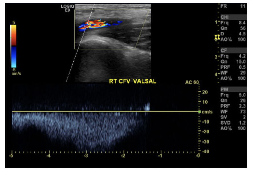 <p>Is this venous valve competant or not? how can you tell. </p>