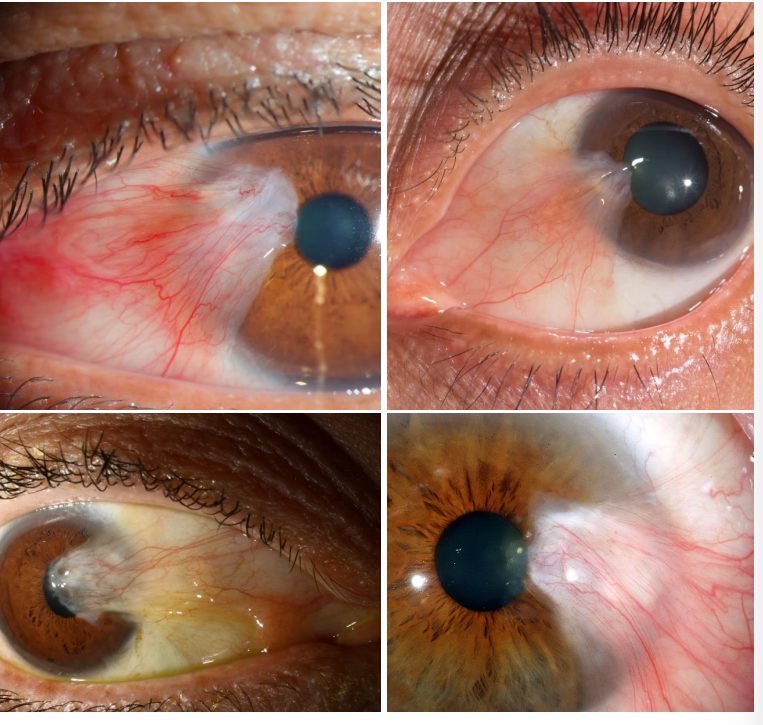 <p>like pinguecula w invasion of fibrovascular tissue <strong><u>into corneal Bowmans layer</u></strong></p>